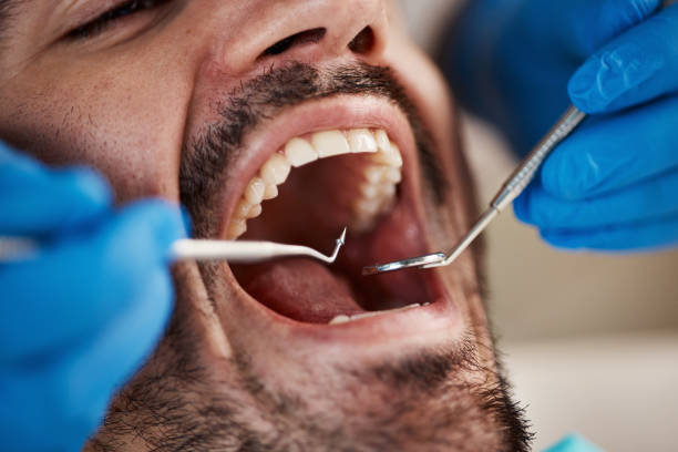 Emergency Dental Filling Replacement in MT